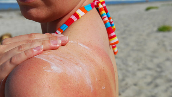 Too Much Sun? Here's The Best Natural After Sun Care